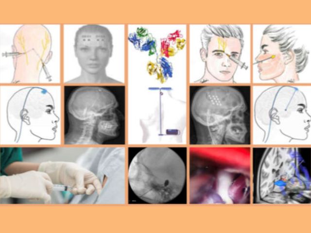 “Teràpies semi invasives i quirúrgiques en Cefalees i Neuràlgies” amb cirurgia en directe